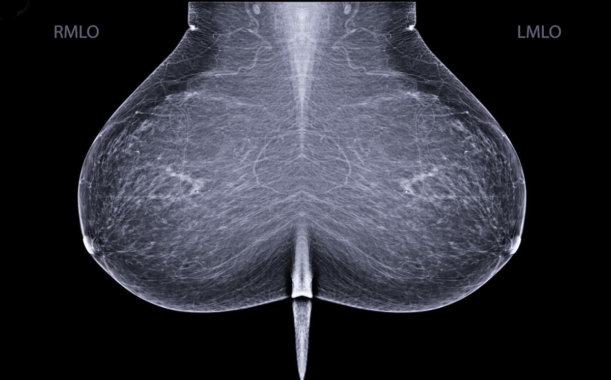 Should Race and Ethnicity Factor into Starting Ages for Mammography Screening?