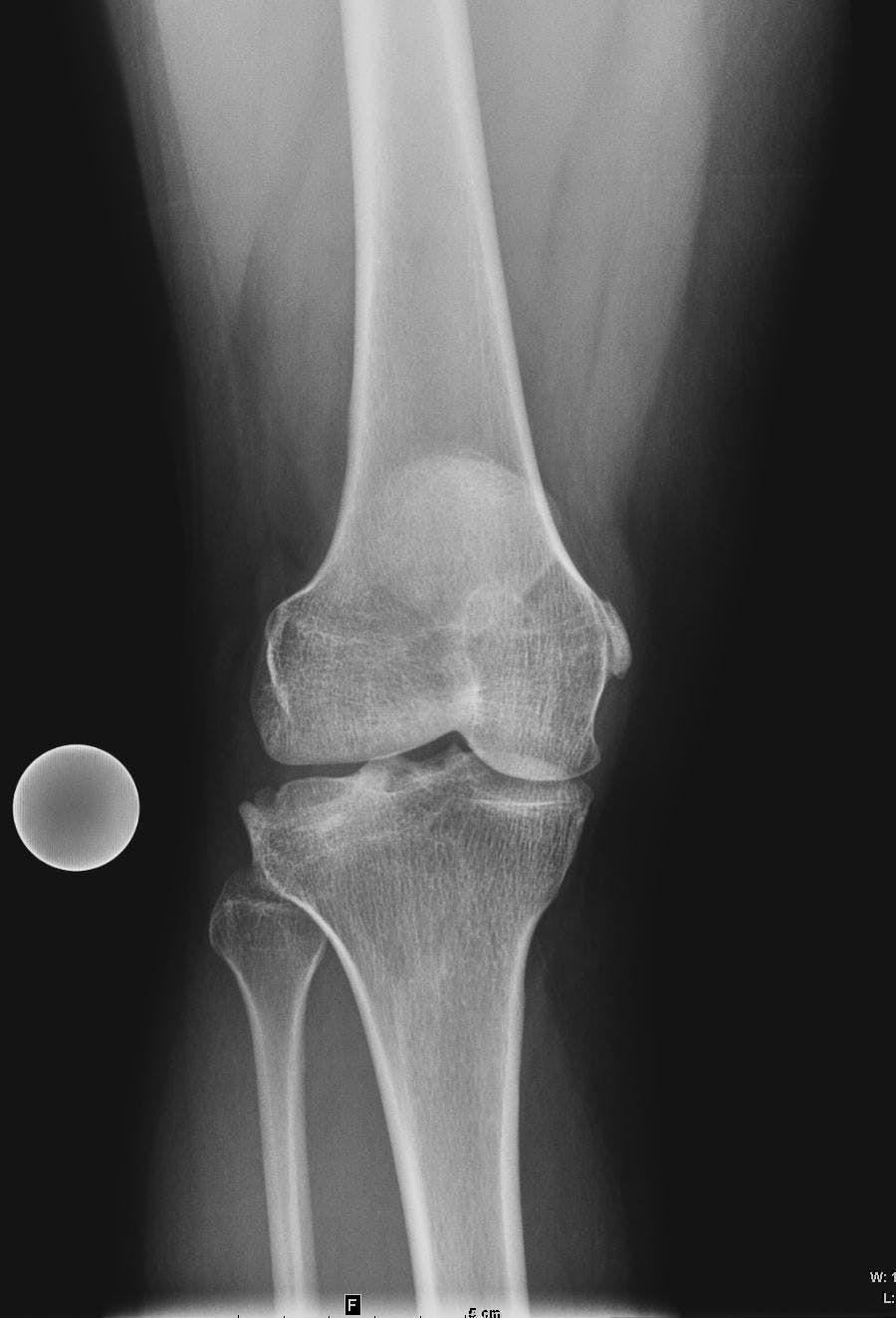 Image IQ: History of Remote Right Knee Injury