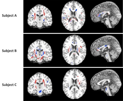 Brain MRI Shows Visual System Changes in Parkinson’s Disease