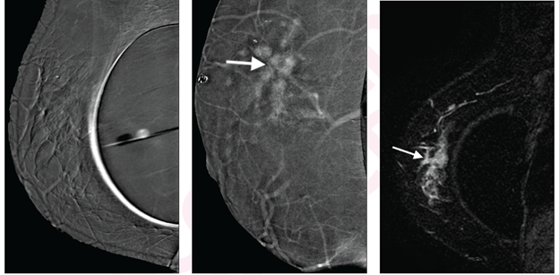 Left to right: Subtraction right mediolateral oblique (MLO) CEM was non-diagnostic because of artifact, potentially due to motion misregistration from extended exposure time; subtraction right MLO implant displaced CEM image shows 5.8 cm enhancing mass (arrow); contrast-enhanced MRI sagittal subtraction image shows concordant mass (arrow).

Credit: American Journal of Roentgenology
