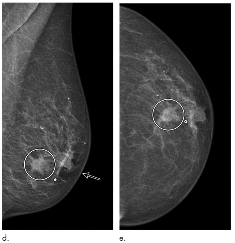 Images in a 72-year-old woman who was diagnosed with a 13-mm lymph node-negative invasive lobular carcinoma luminal B–like human epidermal growth factor receptor 2 breast cancer 18 months after a screening negative for cancer in the Malmö Breast Tomosynthesis Screening Trial. DM images of (d) mediolateral oblique and (e) craniocaudal views at diagnosis, small marker at lump location. increased nipple retraction (arrow) and central mass (circle on d and e).

Courtesy: RSNA