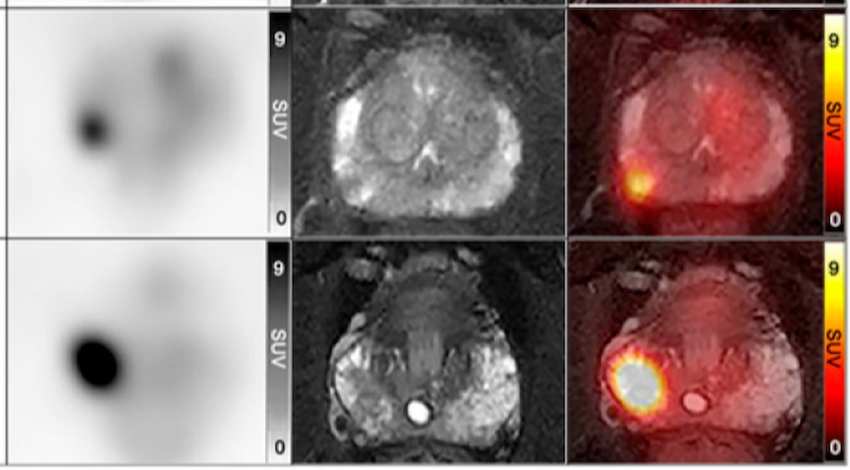 Study: PET/MRI May Prevent Up to 83 Percent of Unnecessary Biopsies in Men with PI-RADS 3 Lesions