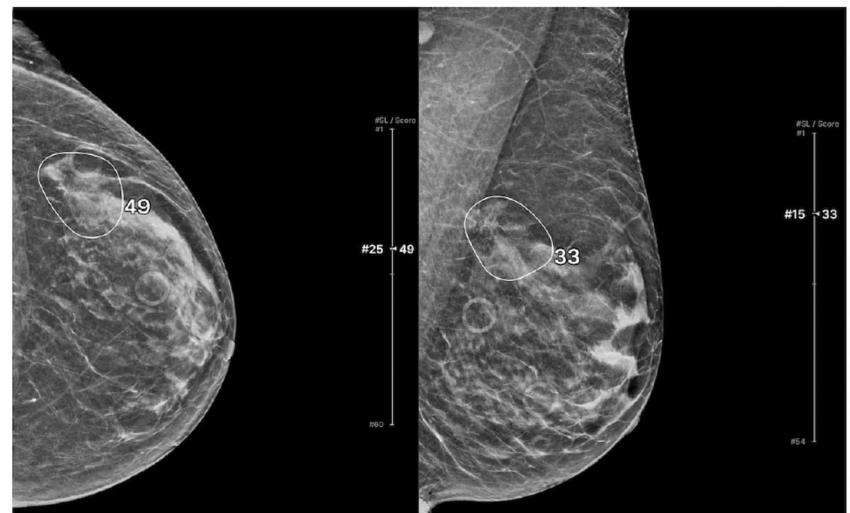 Mammography Study: AI Improves Breast Cancer Detection and Reduces Reading Time with DBT