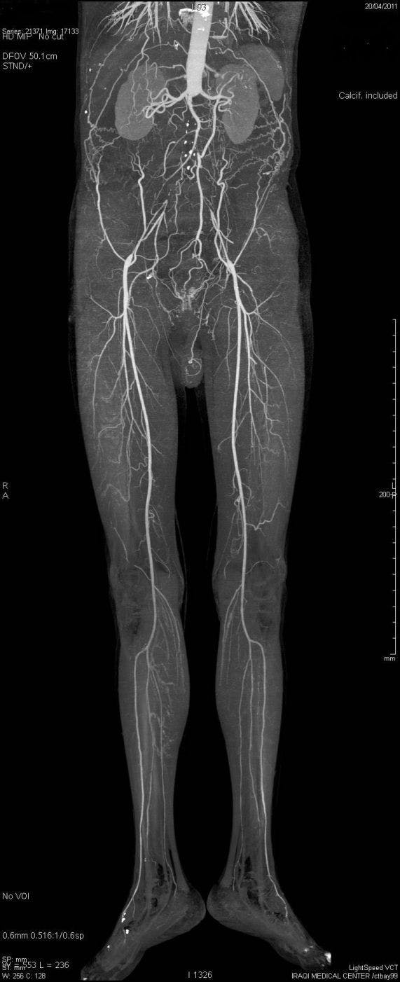 Severe Aortoiliac Disease with Total Occlusion