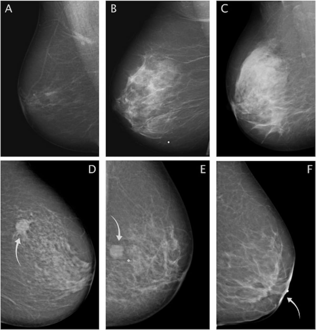Mammography Study Finds No Significant Link Between Breast Density and Breast Cancer Prognosis