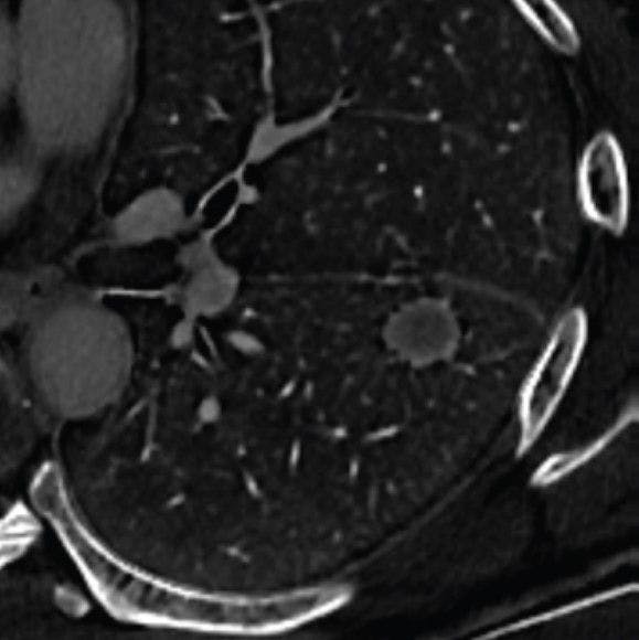 Can Dual-Energy CT Have an Impact in Differentiating Primary Lung Cancer and Pulmonary Metastases?