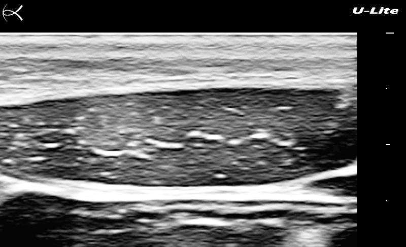 Figure 2. Transverse view over a rectus muscle below the level of the umbilicus. 