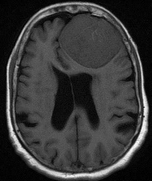 Image IQ: 35-year-old Female with Headaches
