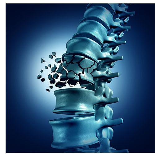 Osteoporotic Vertebral Fractures Underreported