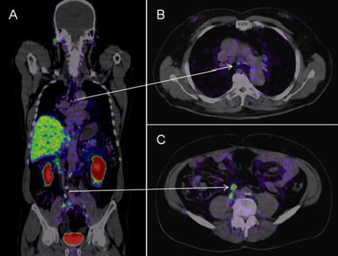 Prostate-Specific Membrane Antigen PET Bests MRI in Biochemical Recurrent Disease 