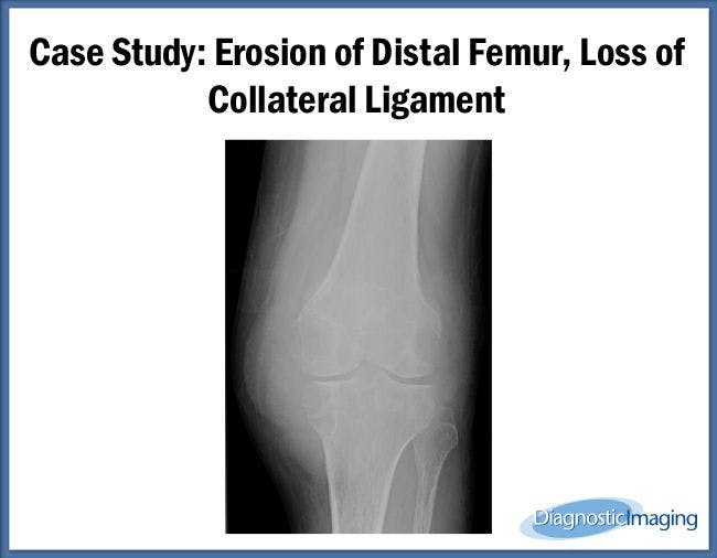 Erosion of Distal Femur, Loss of Collateral Ligament