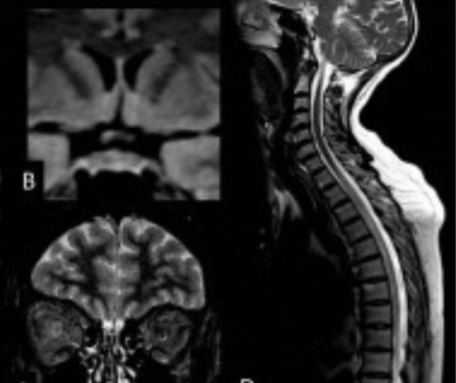 Key MRI Patterns for Diagnosing Inflammatory Brain Stem Lesions