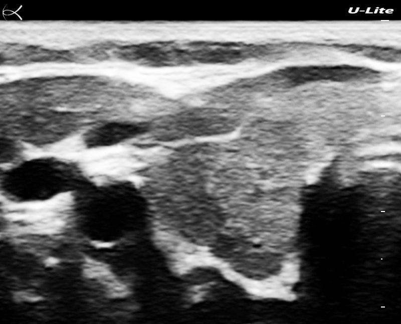Figure 5B. Split-screen of left lobe detail (bottom) views of the thyroid.