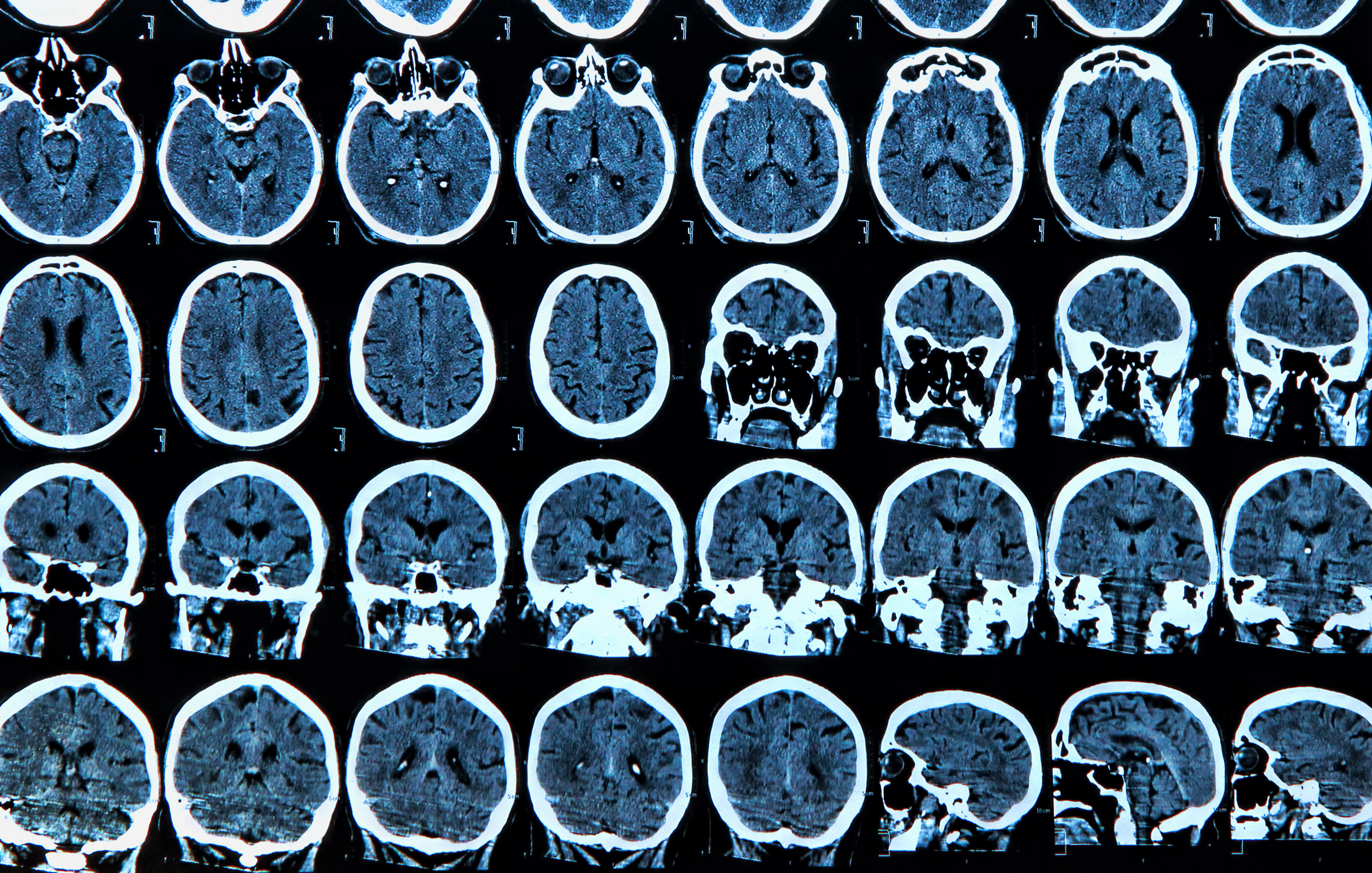 New Study Shows Link Between COVID-19 and Elevated Risks for Neurological Disorders