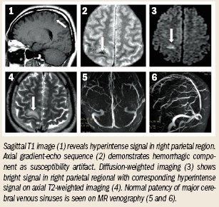 Isolated cortical venous thrombosis