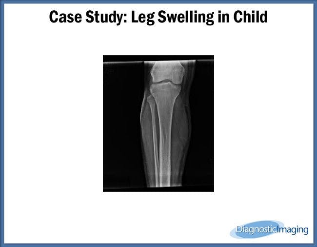 Leg Swelling in Child