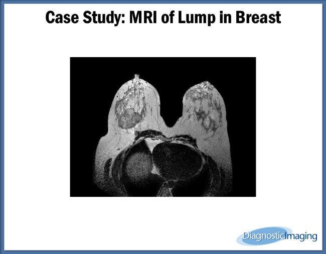 MRI of Lump in Breast