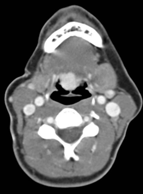 Image IQ: 50-year-old with History of Breast Cancer for Neck CT