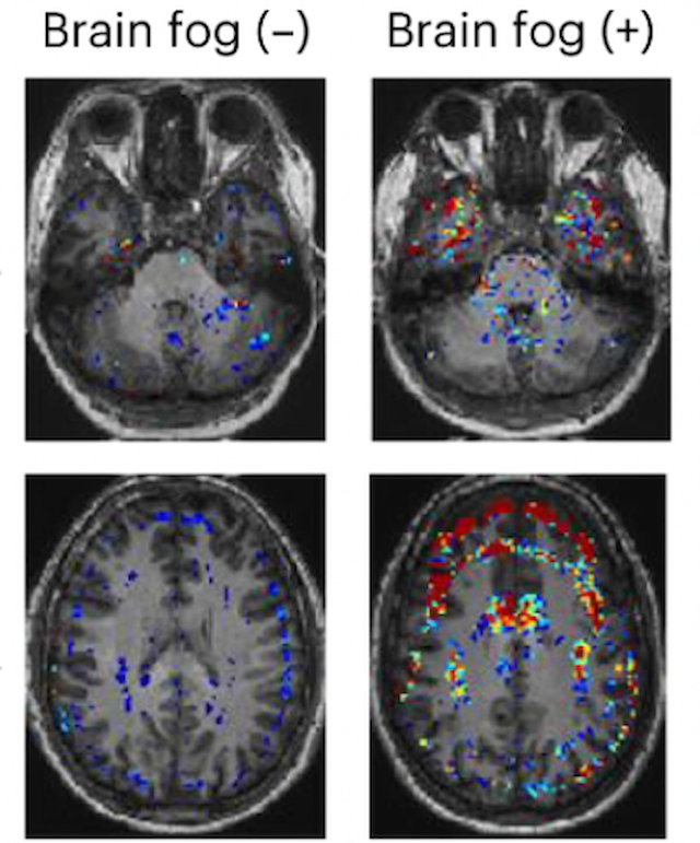 MRI Research Suggests Link Between COVID-19 Related Brain Fog and Blood-Brain Barrier Dysfunction