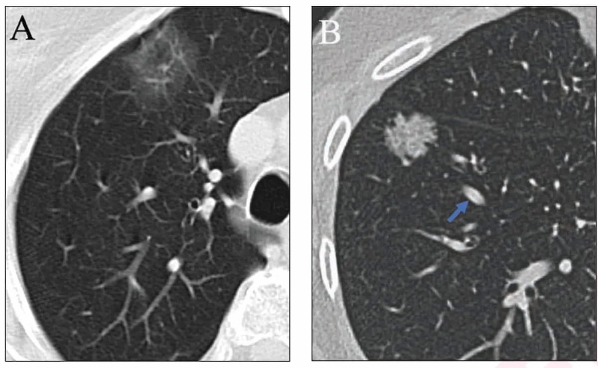 AI Adjudication Bolsters Chest CT Assessment of Lung Adenocarcinoma