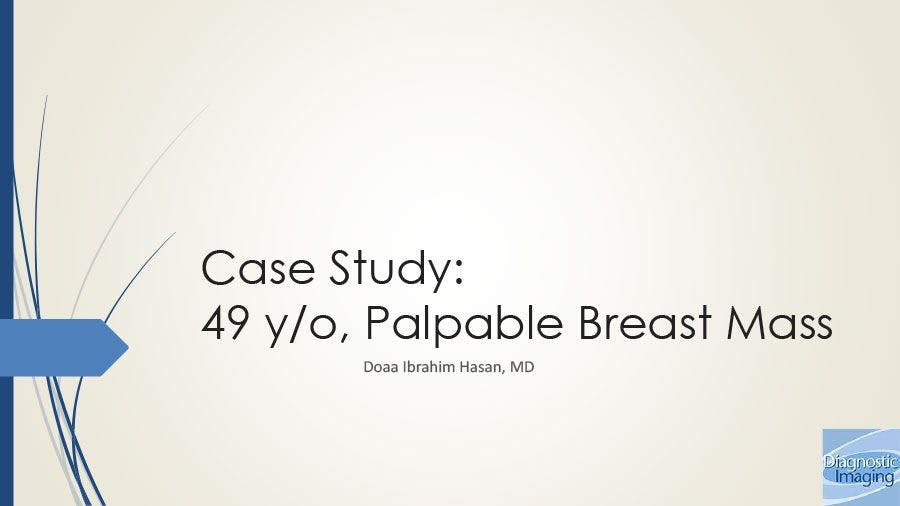 49 y/o, Palpable Breast Mass
