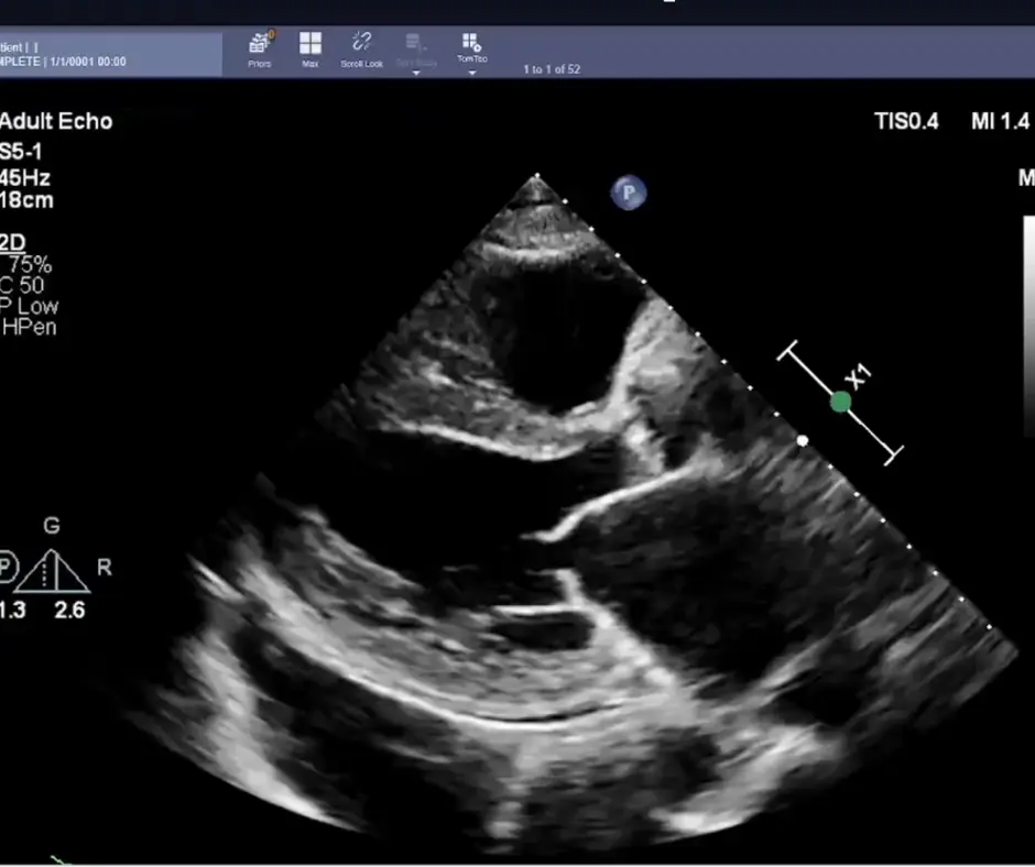 Study Finds AI More Effective Than Sonographer Interpretation of Cardiac Function on Echocardiograms