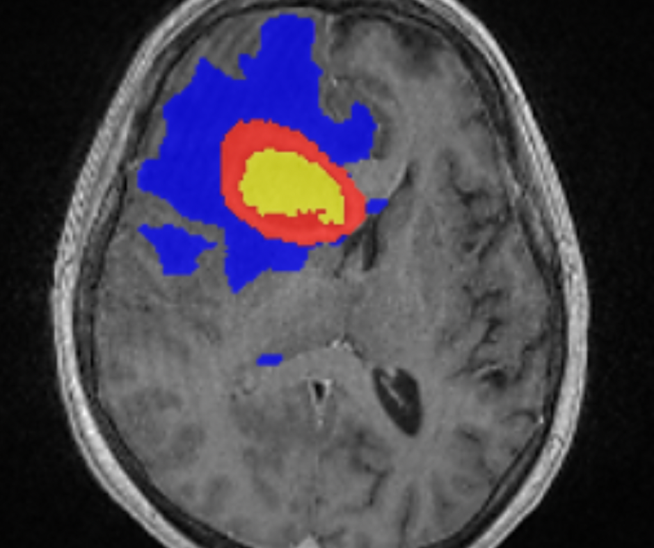 Adjunctive AI Software for Brain MRI Gets FDA Clearance for Assessing High-Grade Gliomas