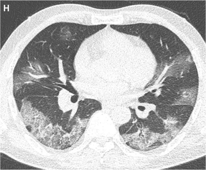 Chest CT Study Shows Benefits of COVID-19 Vaccines in Reducing Incidence and Severity of Related Pneumonia