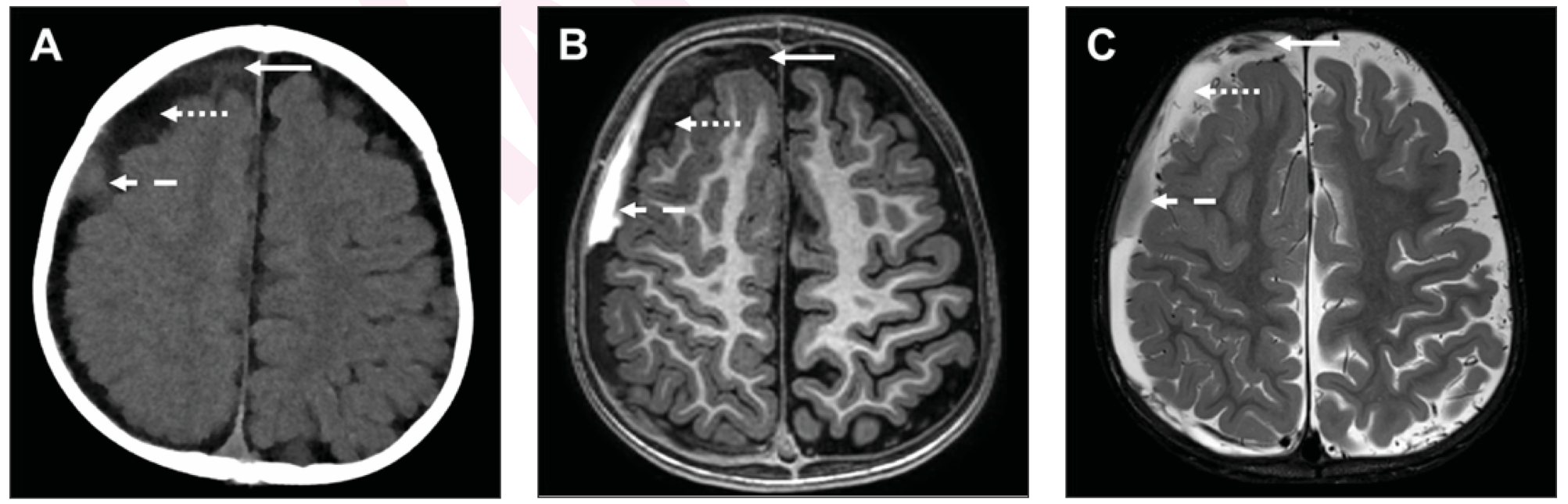 Neuroimaging of the brain in a 1-year-old boy found unresponsive. A) Axial unenhanced CT, B) T1-weighted MRI, and C) T2-weighted MRI demonstrate high-attenuation T1-hyperintense and T2-hypointense extra-axial products (dashed arrow) suggestive of evolving hemorrhage. The non-dependent products (solid arrow) show intermediate attenuation, T1 hypointensity, and T2 hypointensity. The central low-attenuation T1-hypointense and T2-hyperintense material (dotted arrow) suggests admixture of cerebrospinal fluid.

Credit: American Journal of Roentgenology