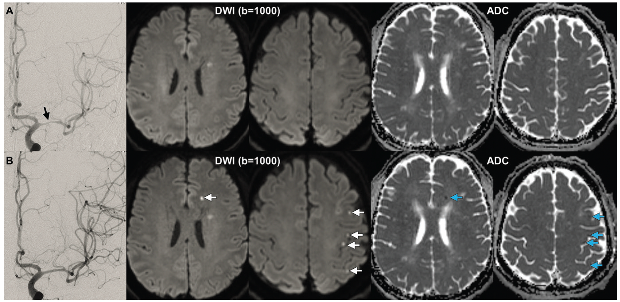 Post-Op MRI Shows New Ischemic Brain Lesions in 65 Percent of Patients After Endovascular Surgery for Intracranial Atherosclerotic Stenosis