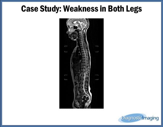 Weakness in Both Legs