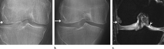 Tomosynthesis Shows Promise in Knee Imaging