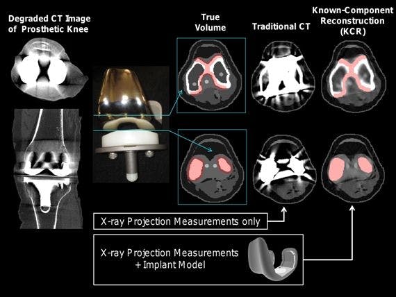 New CT Technique Shows Joint Implant Location