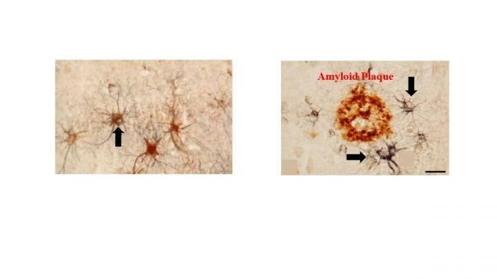 Astrocytes in the brain of a deceased patient with Alzheimer's disease. (Right) The black arrows show astrocytes surrounding amyloid plaques in the brain of a deceased patient with Alzheimer's disease.

Credit: Amit Kumar