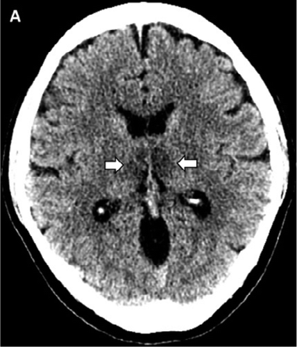 A, Image from noncontrast head CT demonstrates symmetric hypoattenuation within the bilateral medial thalami (arrows). B, Axial CT venogram demonstrates patency of the cerebral venous vasculature, including the internal cerebral veins (arrows). C, Coronal reformat of aCT angiogram demonstrates normal appearance of the basilar artery and proximal posterior cerebral arteries. Courtesy: RSNA