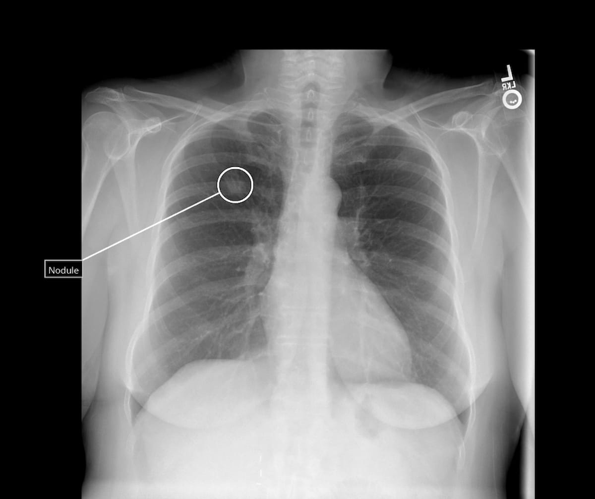 FDA Clears AI Software for Enhanced Lung Nodule Detection on Chest X-Rays