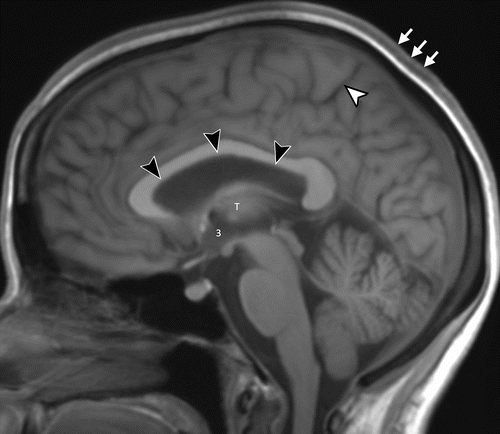 Reconstructed sagittal 5-mm orthogonal midline images in the brain using the sagittal three-dimensional T1-weighted data set. Matching postflight image (postflight day 1) in the same astronaut. The black arrowheads show upward expansion of the anterior, middle, and posterior superior margins of the lateral ventricle with associated narrowing of the marginal sulcus of the cingulate sulcus (white arrowhead). There is subtle expansion of the third ventricle (indicated by a 