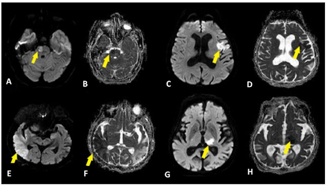 New Meta-Analysis Details Most Common Brain MRI Findings with COVID-19