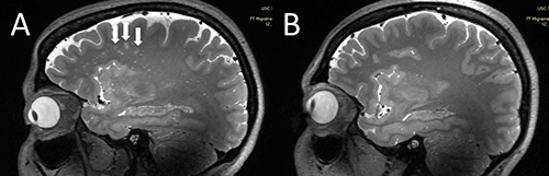 Ultra-High-Resolution MRI Identifies Enlarged Perivascular Spaces in People with Migraines