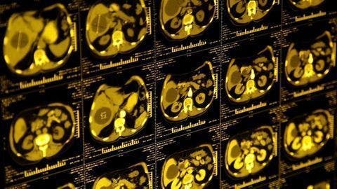 Low-Dose CT Lung Screening Gets Boost from AI
