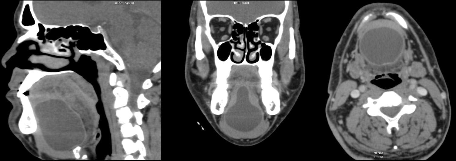 Image IQ: 16-Year-Old Presenting with Swelling Beneath the Tongue and Discomfort