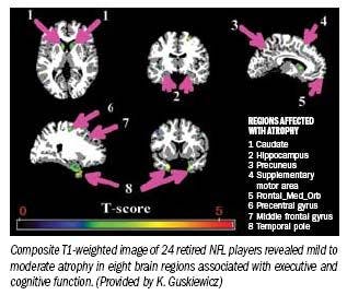 MRI reveals sport-related brain damage