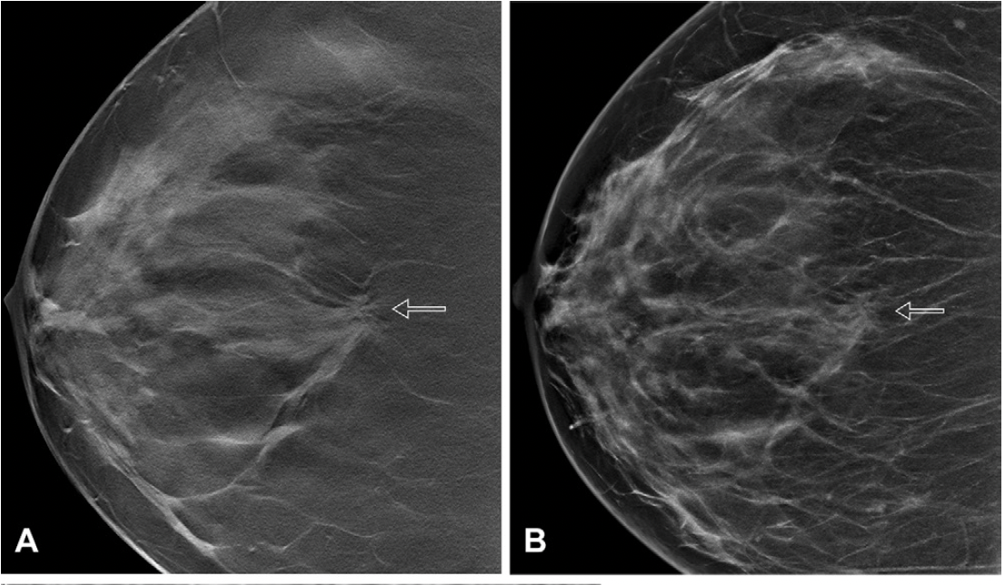 Digital Breast Tomosynthesis and Breast Density: What a New Study Reveals