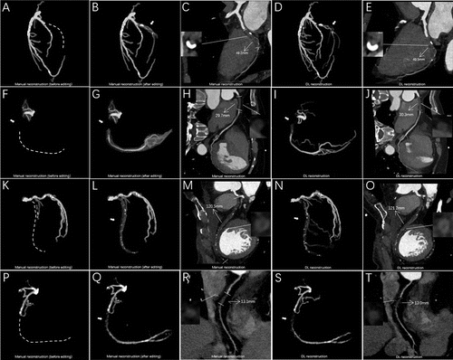 Deep Learning Improves CT Guidance for Revascularization of Coronary Total Occlusions