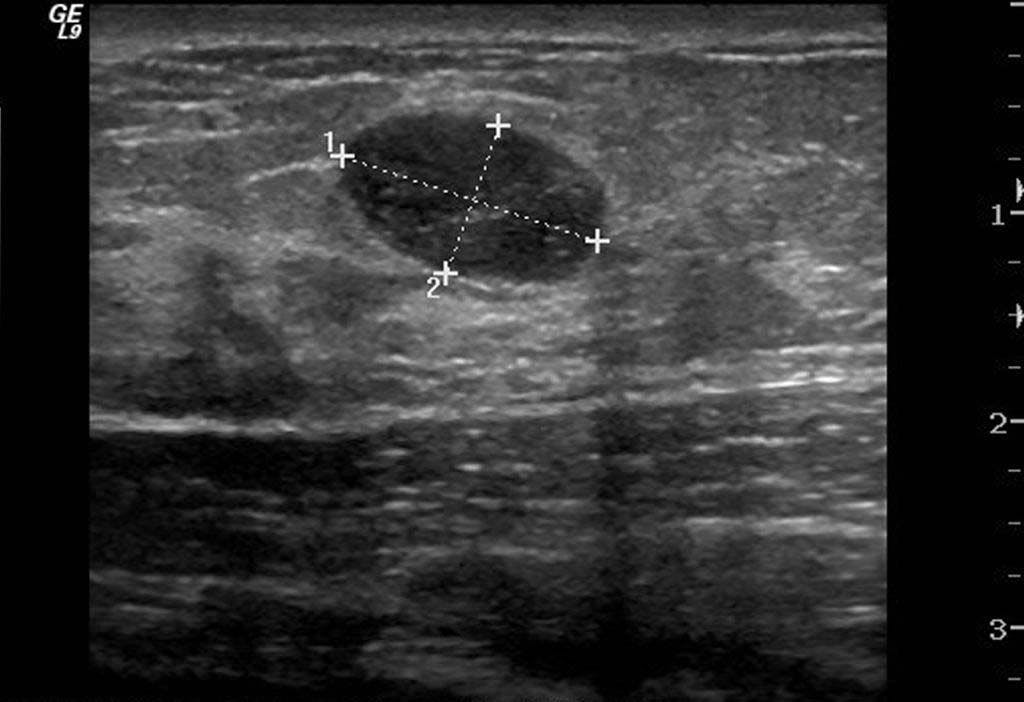 Breast ultrasound spares young women unnecessary biopsies