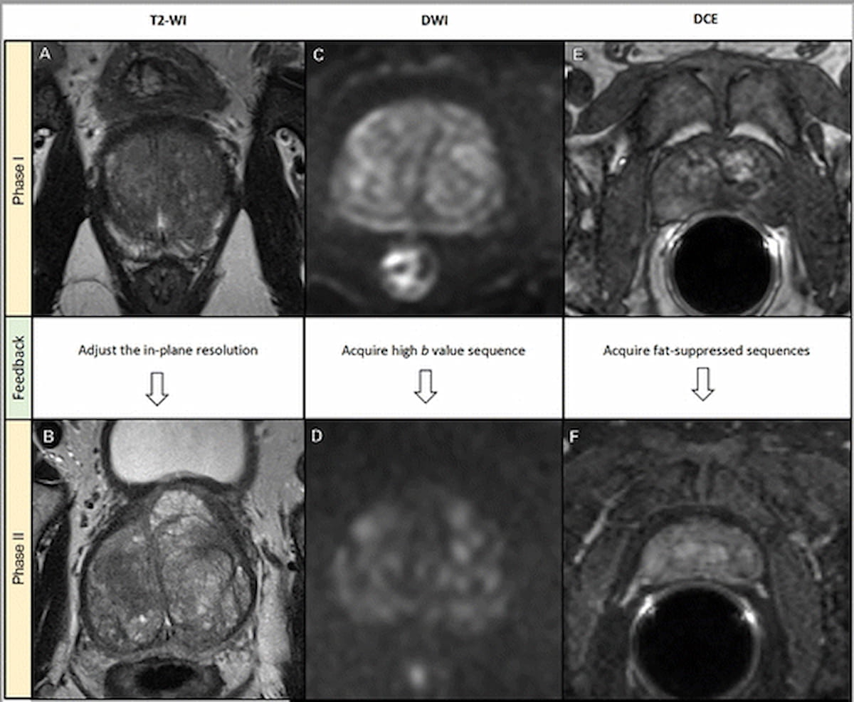 Multinational Study Suggests High Variability with Quality of Prostate MRI