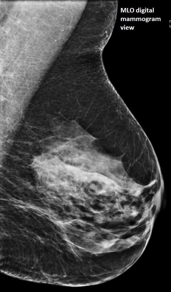 Image IQ: 57-year-old with Dense Breasts, Spiculated Mass