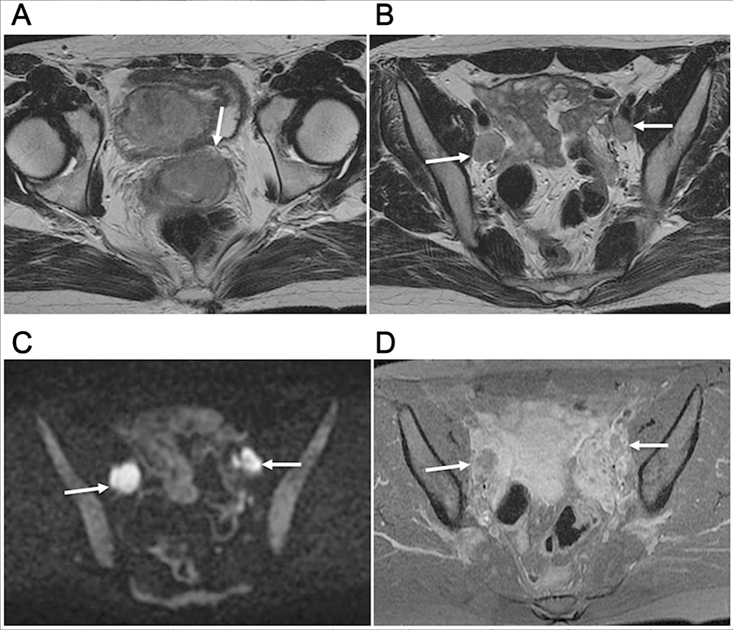 MRI Accurately Stages Cervical Neuroendocrine Carcinoma