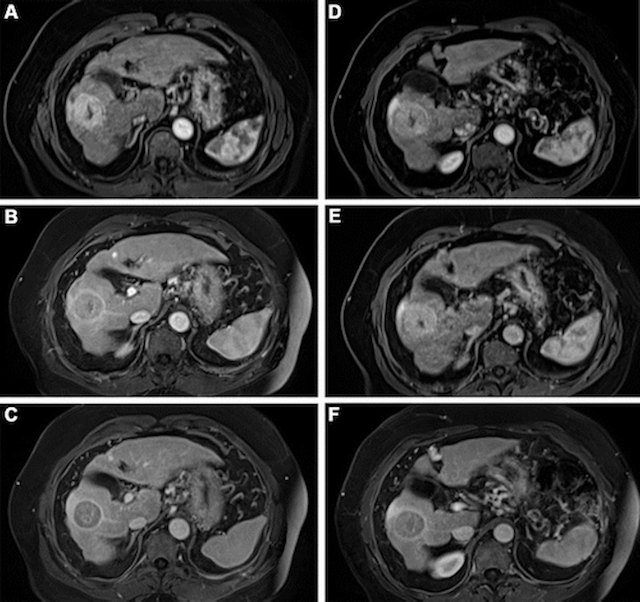MRI Study: Half-Dose Gadopiclenol Offers Similar Visualization and Safety as Full-Dose Gadobutrol