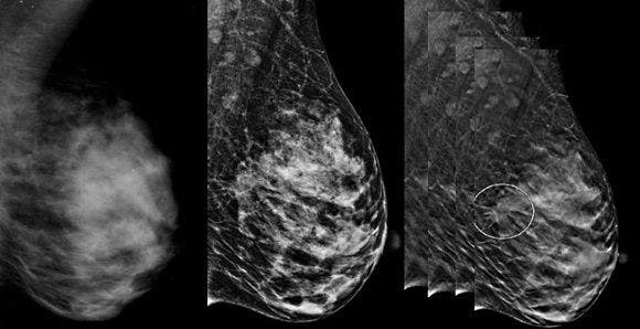 Digital Breast Tomosynthesis Shows Promise in Community Setting 